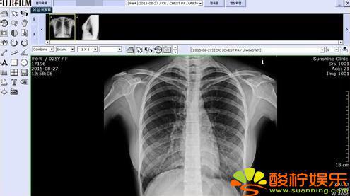 韩国性感女模被指隆胸 发胸部X光照片以证清白